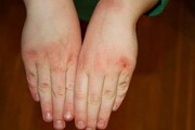 دلایل اصلی خشکی پوست دست