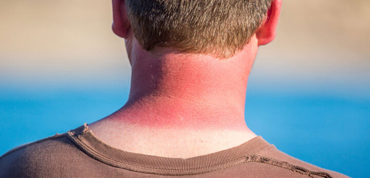 درمان سریع آفتاب سوختگی با ۱۰ روش موثر