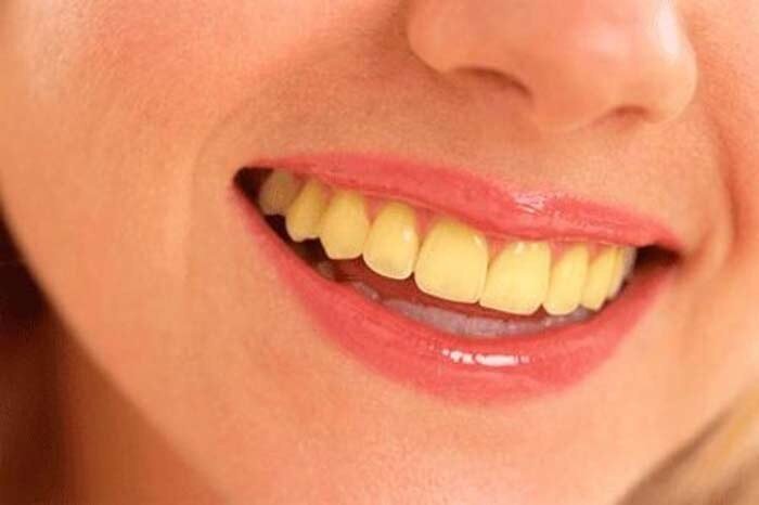  3 دلیل اصلی تغییر رنگ دندان ها