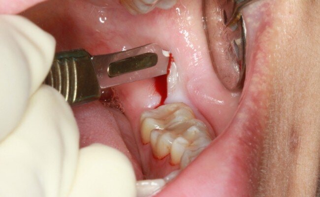  ایمپلنت دندان چگونه انجام می شود؟