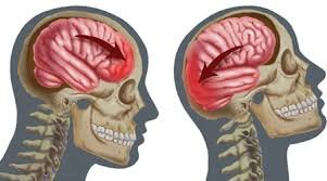 چگونه ضربه مغزی می تواند بر حافظه شما تأثیر بگذارد؟