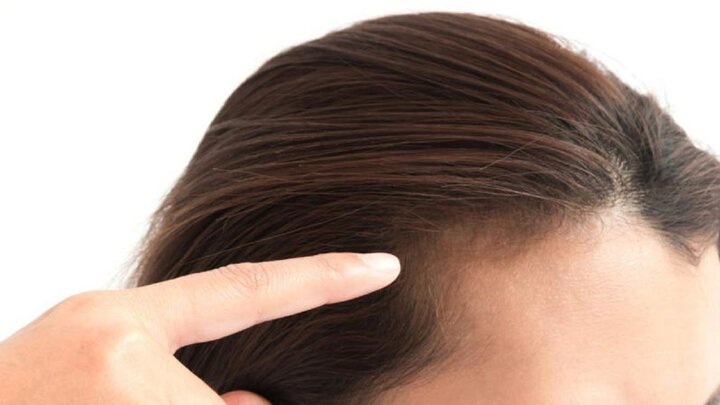 علت ریزش مو در فصل پاییز و روش جلوگیری از آن