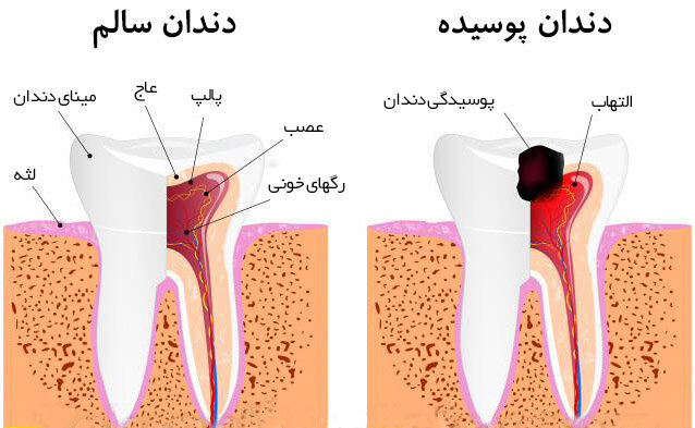 علت پوسیدگی دندان چیست؟ / ده عامل خرابی دندان