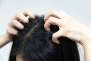 درمان شوره سر با چند روش ساده و خانگی