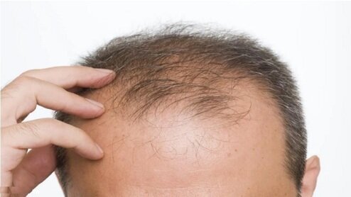 علت ریزش مو فصلی چیست؟