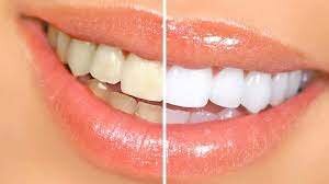 دندان سفید