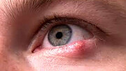 علائم تبخال چشم و نحوه درمان آن / جزئیات
