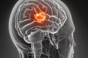 علائم تومور مغزی کدام است؟ | تومور مغزی را بهتر بشناسید