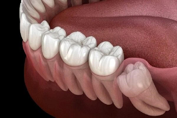 دلیل وجود دندان عقل و کار آن در دهان چیست؟  / جزئیات