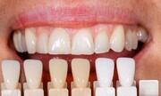 سفید کردن دندان‌ها به روش های طبیعی و ساده خانگی