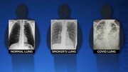 وضعیت وخیم ریه بیمار کرونایی در مقایسه با ریه فرد سیگاری / عکس