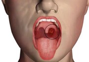 نشانه های ابتلا به سرطان دهان