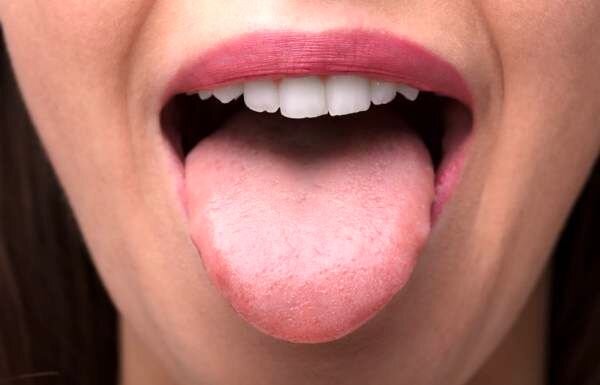 علائم ابتلا به سرطان زبان