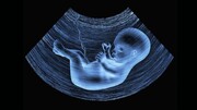افزایش سقط های غیرقانونی با حذف غربالگری جنین
