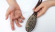 دلایل اصلی ریزش موی ناگهانی چیست؟