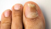 درمان قارچ ناخن پا با چند ترفند ساده خانگی