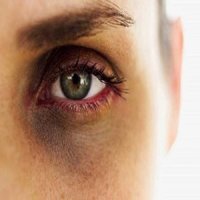 علت کبودی و تیرگی دور چشم چیست؟ | رفع تیرگی و سیاهی دور چشم با چند روش ساده خانگی