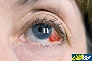 علت ایجاد لکه های قرمز داخل چشم چیست؟