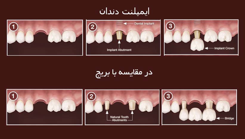 تفاوت های ایمپلنت و بریج دندان چیست؟
