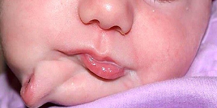 تولد نوزادی عجیب با دو دهان/ عکس