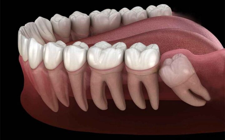 نکشیدن دندان عقل چه بلایی سر دیگر دندان‌ها می‌آورد؟