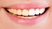 علت زرد شدن و تغییر رنگ دندان چیست؟