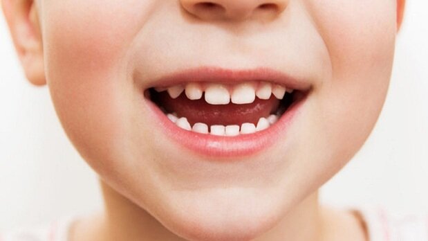 تاثیرات بدی که پوسیدگی دندان‌های شیری بر روی فک و صورت می‌گذارد
