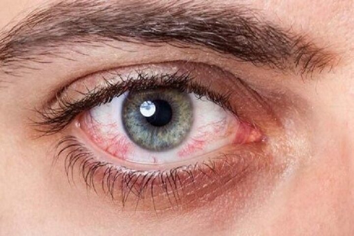 مهم‌ترین دلایل بروز قرمزی چشم و نحوه درمان آن