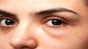 دلیل پف کردن زیر چشم چیست؟ | درمان پف زیر چشم با چند روش ساده و خانگی