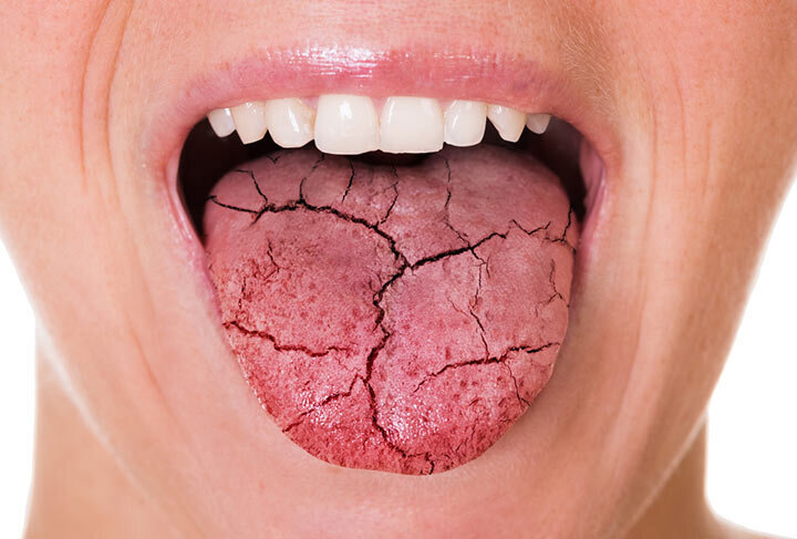 علت خشکی دهان و خارش گلو چیست؟ + نحوه درمان