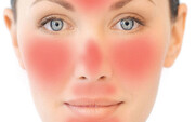 درمان خانگی قرمزی پوست صورت + علایم