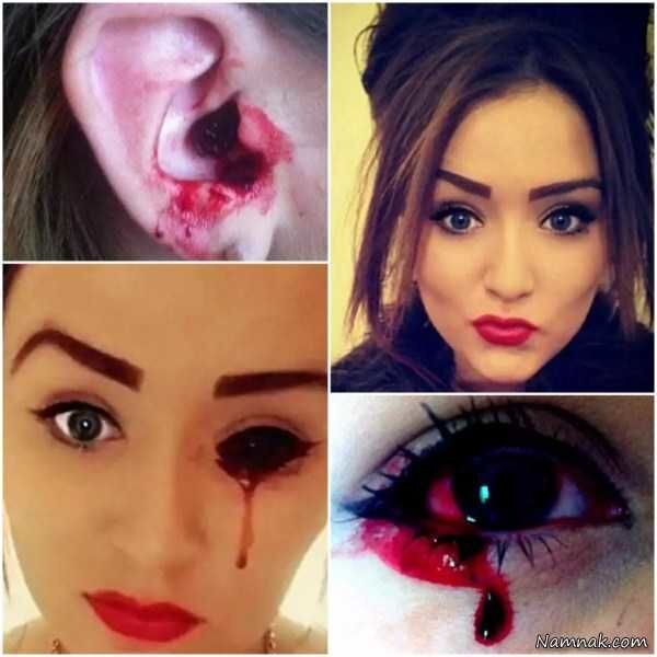 دختر ۱۷ ساله‌ای که از چشمانش خون می ‌بارد / عکس