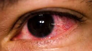 علایم و دلایل بروز قرمزی چشم | درمان قرمزی چشم با چند روش ساده خانگی