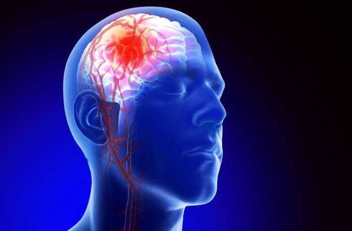 لخته مغزی دقیقا چیست؟