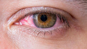 هاله زرد رنگ اطراف چشم، نشانه چیست؟