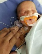تولد نوزاد بدون چشم در بیمارستان! / عکس