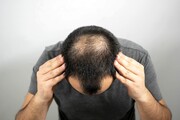 مشکلاتی که استرس بر سر موهایتان می‌آورد؟