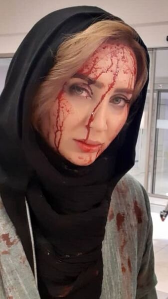 چهره پر از خون سولماز حصاری /عکس