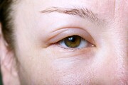 علت پُف کردن صورت و اطراف چشم‌ها بعد از بیدار شدن از خواب و راه‌های درمان آن