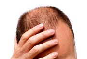 پیشگیری و درمان ریزش مو با مصرف این خوراکی‌ها / عکس