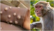 ویروس «آبله میمونی» چیست و چقدر خطرناک است؟