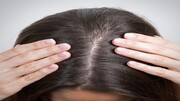پرپشت کردن طبیعی موها با چند روش ساده خانگی | چگونه می‌توان تراکم موها را اندازه گرفت؟