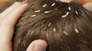 درمان شپش سر با چند روش ساده و خانگی | تفاوت شپش و شوره سر چیست؟