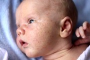 درمانی فوری عرق سوز شدن گردن نوزاد در خانه