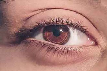 همه چیز درباره پرش پلک چشم یا تیک عصبی چشم + علت بروز و نحوه درمان آن