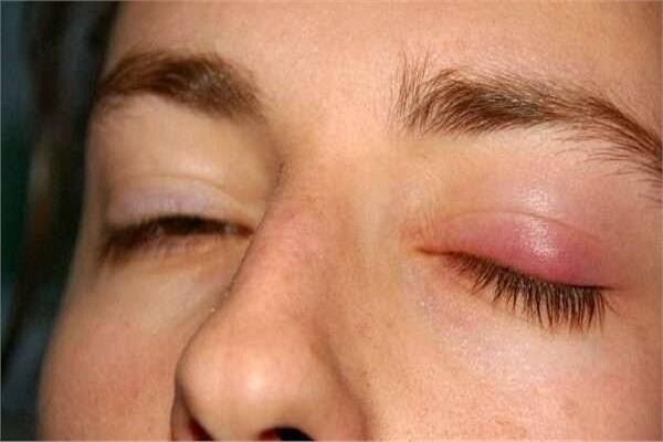 علت بروز و نحوه درمان کیست‌ چربی چشم