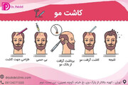 کاشت مو چگونه انجام می شود؟ انواع روش ها,عوارض
