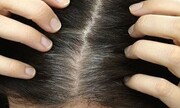 آیا موها می توانند یک شبه سفید شوند؟ | علت سفید شدن مو چیه؟