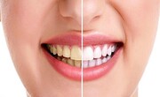 سفید کردن دندان‌ها با رعایت چند نکته ساده