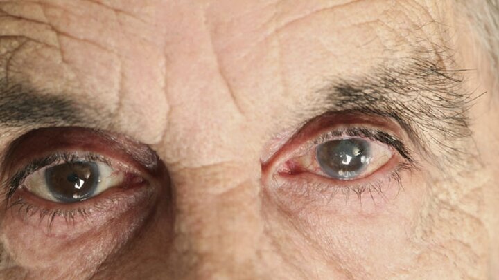 بینایی پیرمرد ۶۱ ساله پس از ۵۰ سال! / عکس